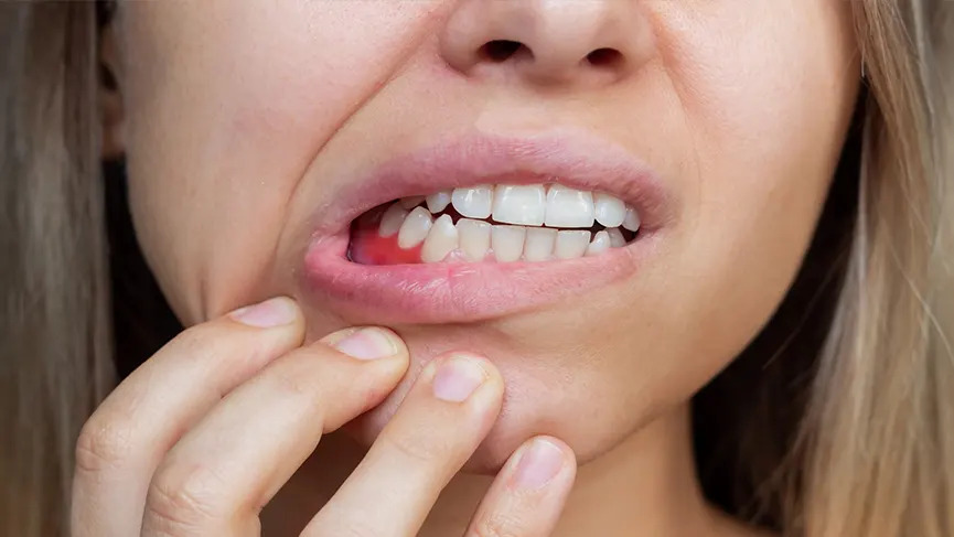 Skorbüt Nedir, Neden Olur? Belirtileri ve Tedavisi